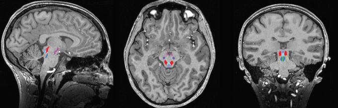 fMRI image of the human brain while asleep.